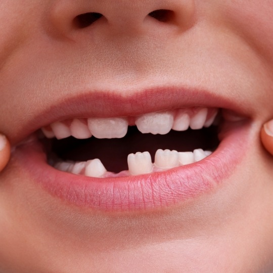 Close up of smiling child missing a few teeth