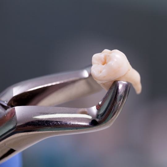 Dental clasp holding an extracted tooth